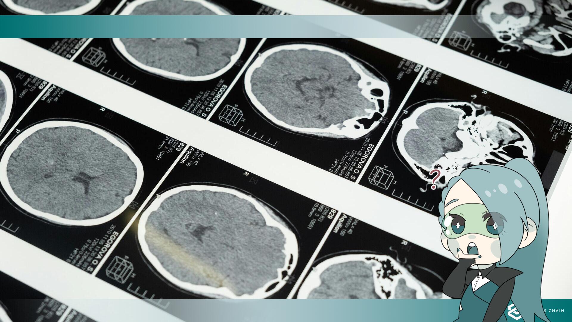  Il primo impianto di Neuralink si è parzialmente staccato dal cervello del paziente.